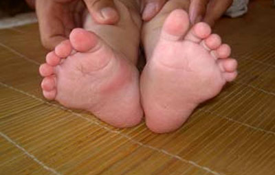 Chinese Baby Born With 12 Fingers and 12 Toes